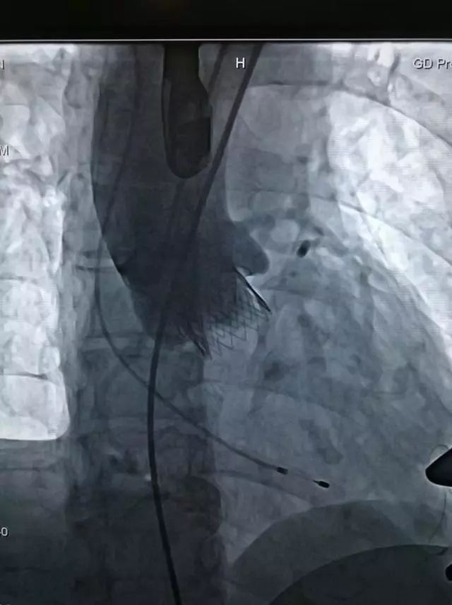 微新闻｜心脏“阀门”关不紧，专家妙手装“新门”——华南中医系统首例！广东省中医院完成经心尖微创主动脉瓣置入术（TAVI）