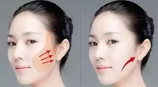 线雕提升的效果图,线雕青春定格术多久消肿