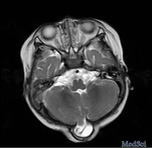 b超误诊脑膨出的概率,bmj临床特征