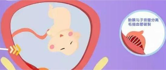 生孩子时，先破水还是先见红？其实差别挺大的！