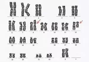 胎停育有多崩溃,如何走出胎停育的阴影