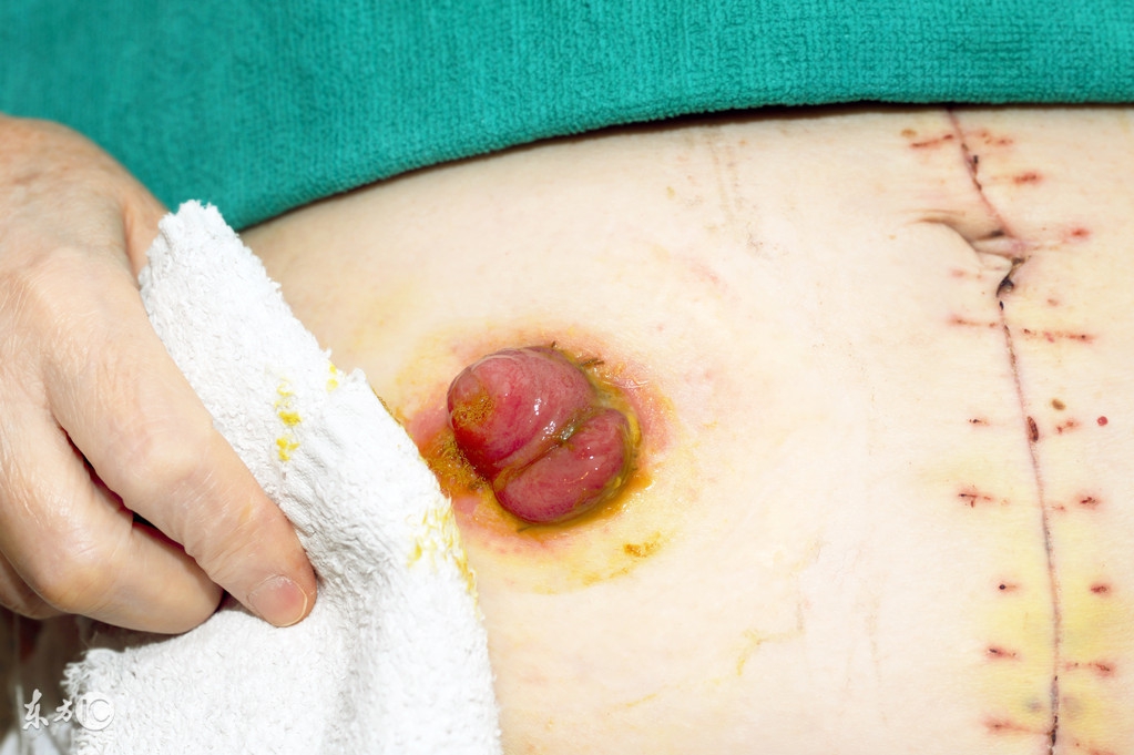 结肠溃疡会导致肠子肿起来吗,结肠是什么原因造成的