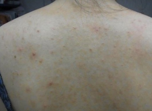 后背经常起疙瘩痘痘怎么回事,后背皮肤会长疙瘩