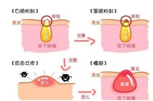 去除痘痘黑头粉刺的药膏,淡化痘印和黑头粉刺药膏