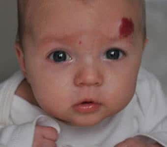 胎记的意义是什么,脚踝长胎记有什么意义