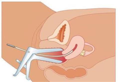 让准妈妈们闻风丧胆的“侧切”，只有遇到下面几种情况才需要进行