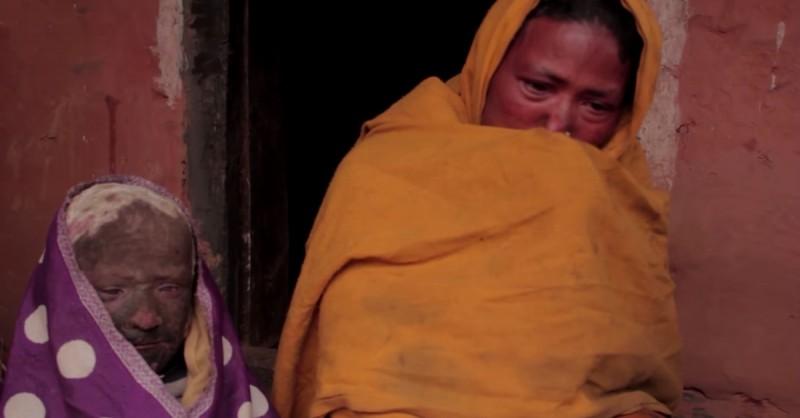 小男孩一出生就得到了一种怪病,男孩从小智力有残缺长大后被孤立