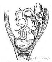 臀位提前破水怎么预防,临产破水怎么办