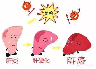 运动后转氨酶升高,喝中药转氨酶升高