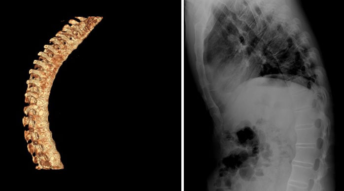 强直性脊柱炎的临床诊断,强直性脊柱炎诊断标准与治疗