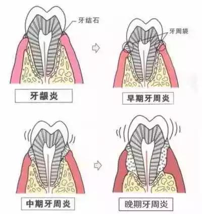 牙齿松动会导致牙疼吗,牙齿松动会引起腮帮子痛吗