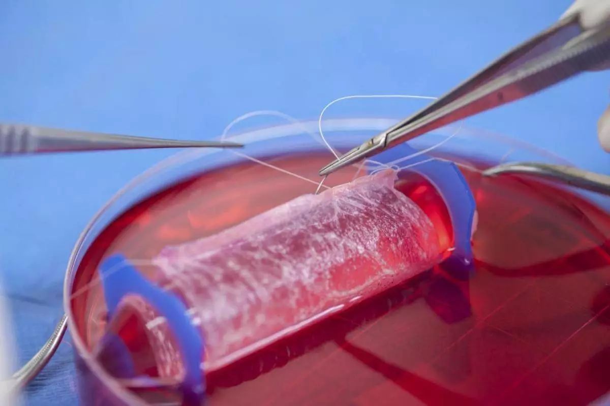 中国首例子宫移植成功案例,全球首例男性子宫移植成功