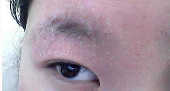 教你一招懒人改善敏感肌的方法,敏感肌改善最好的方法