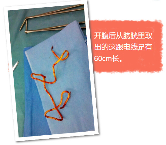 一根火柴引发的血案,一根线引发的惨案