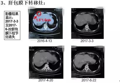 2023nkt细胞治疗肺癌效果,nkt肺癌免疫治疗