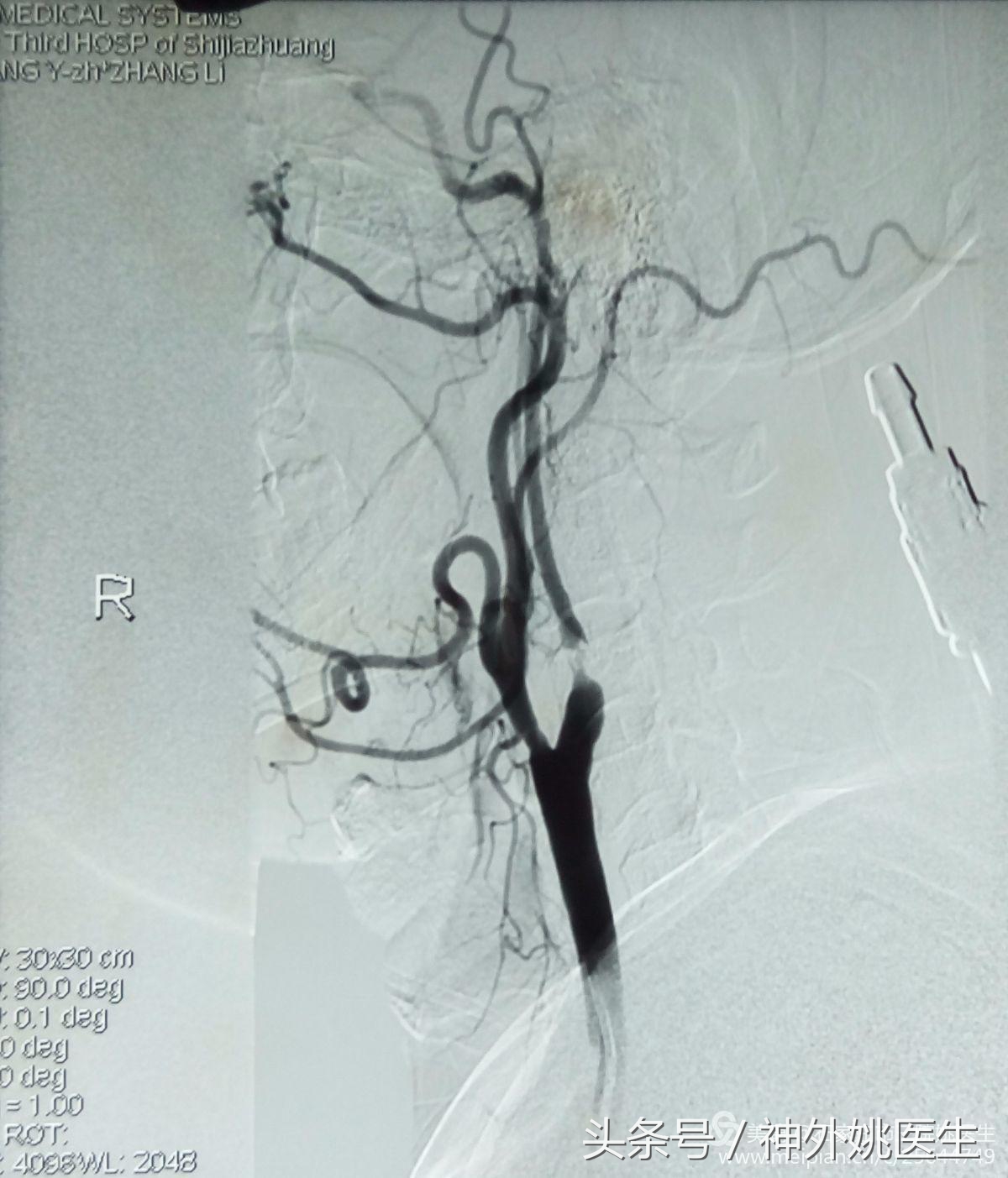 颈内动脉狭窄可以做内膜剥脱术吗,颈内动脉内膜剥脱手术指征