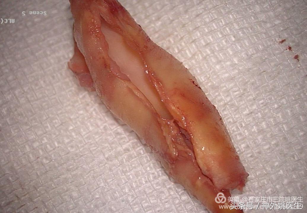 颈内动脉狭窄可以做内膜剥脱术吗,颈内动脉内膜剥脱手术指征