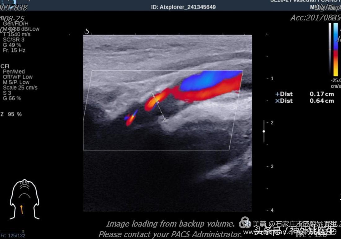 颈内动脉狭窄可以做内膜剥脱术吗,颈内动脉内膜剥脱手术指征