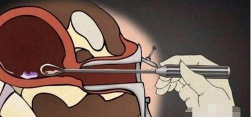 堕胎时人类是怎样一步步杀死自己孩子的?妈妈会看哭!