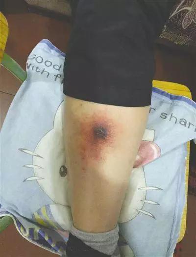 清洁工被蛇咬了,清洁工被狗咬怎么处理