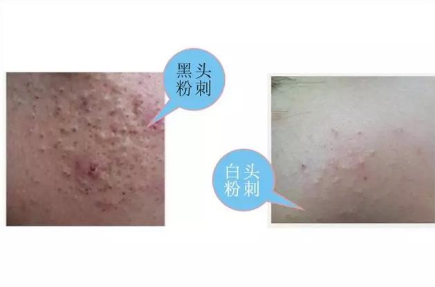 祛除白头粉刺涂阿达帕林,学生长白头粉刺怎么祛除
