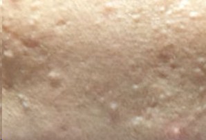 孩子脸上长闭合性粉刺怎么去除,脸上长闭合性粉刺和痤疮怎么办