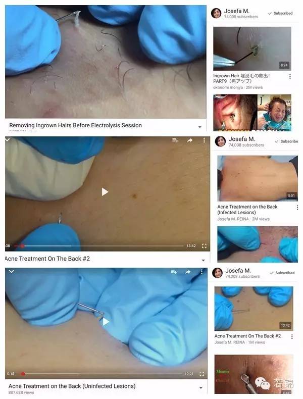 挤黑头过程留一个坑,挤黑头的工具如何使用图解