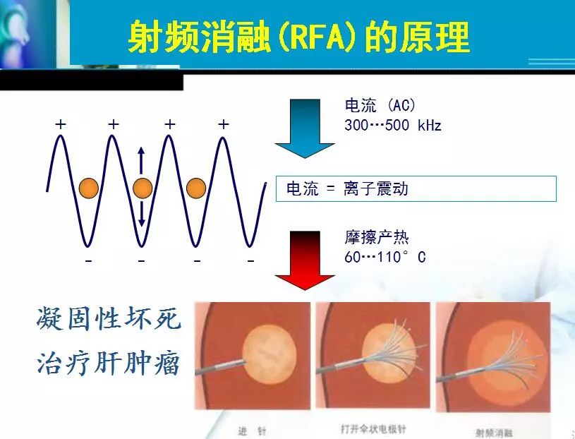 胆管肿瘤射频消融术,肿瘤射频消融厂家