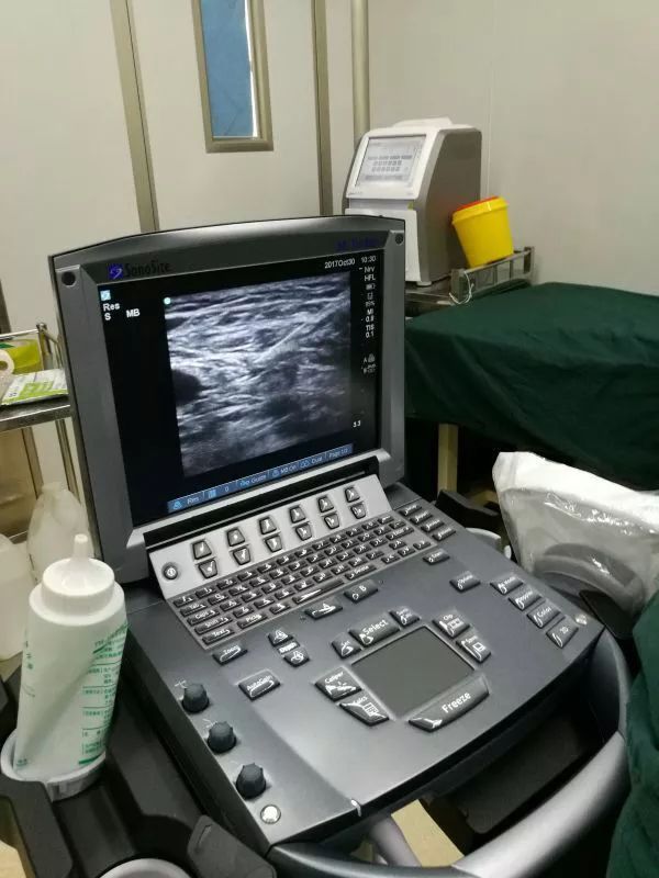 超声引导隐神经阻滞视频教学,超声引导下腰椎旁神经阻滞视频