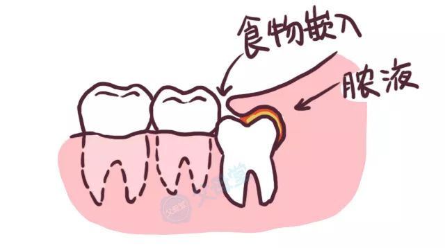 牙齿缺损能通过种植牙解决吗,牙齿缺损可以直接拔掉吗