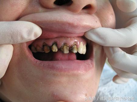 烤瓷牙表面掉瓷了对人身体有害吗,钴铬合金烤瓷牙对身体有害吗