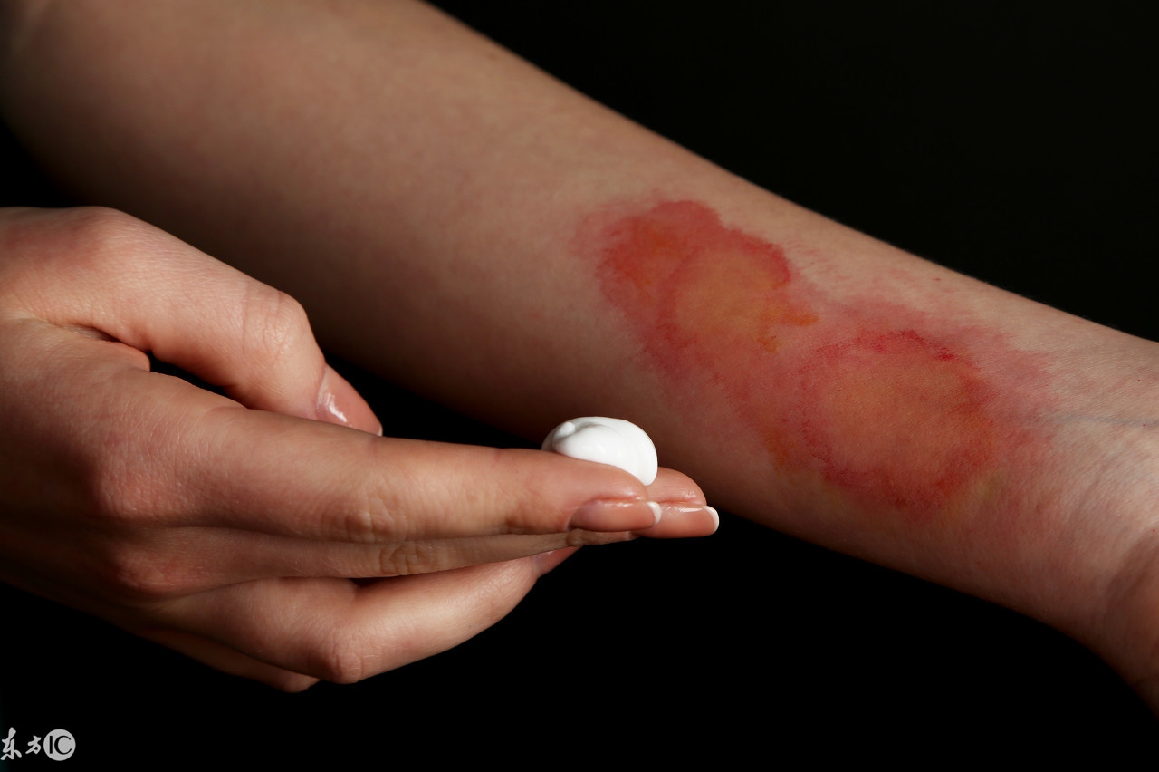 被开水烫伤怎么办最快最有效止疼,被开水烫伤应该怎么缓解