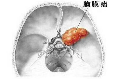 脑膜瘤手术后面部还是麻木,脑膜瘤手术后出现间歇性失语
