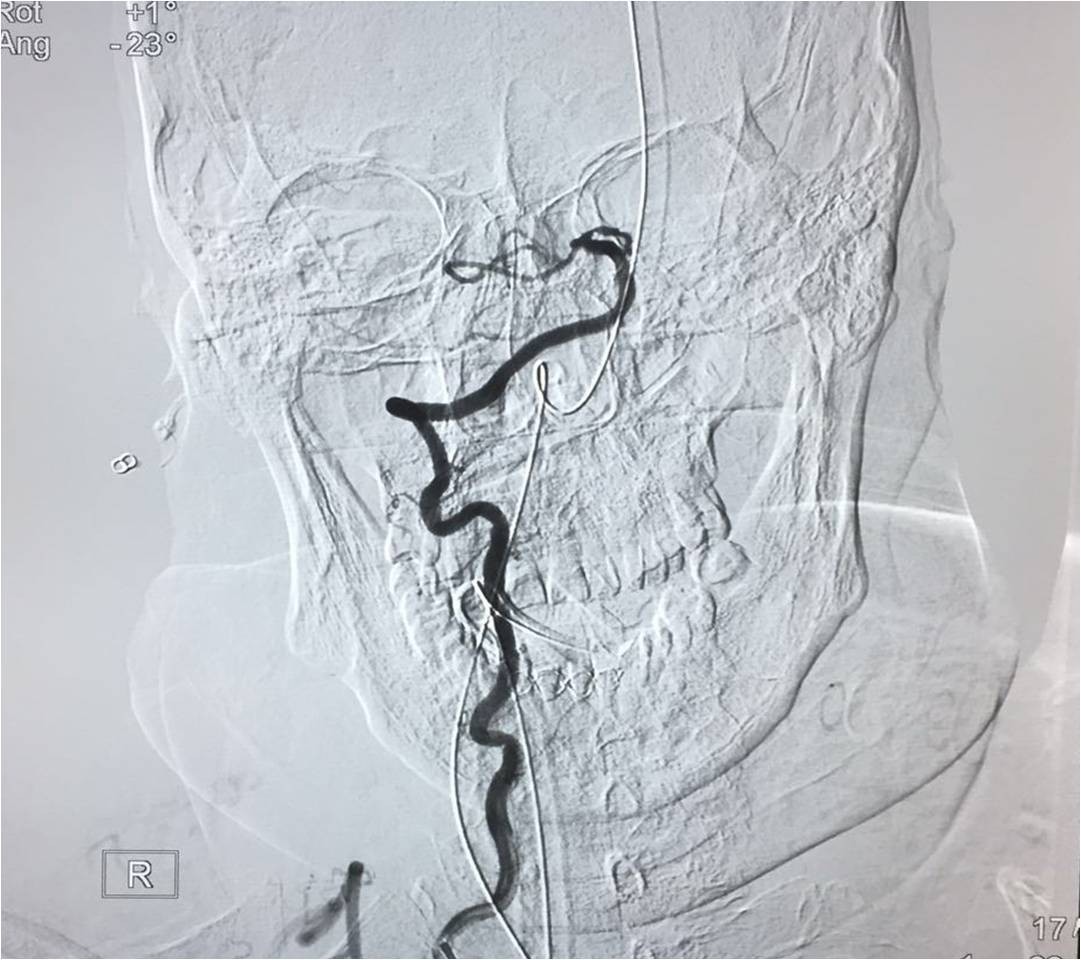 取栓慢性闭塞如何避免血栓逃逸,急性大脑中动脉栓塞取栓时间