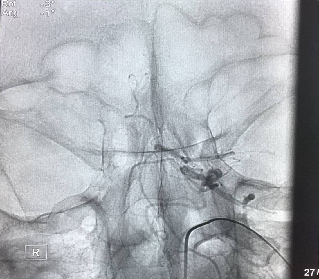 取栓慢性闭塞如何避免血栓逃逸,急性大脑中动脉栓塞取栓时间