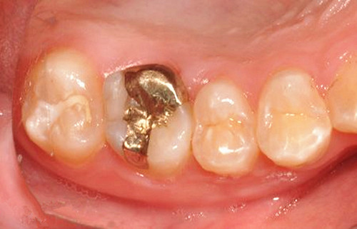 中老年牙龈出血是怎么回事,老年人牙龈出血吃什么药治疗