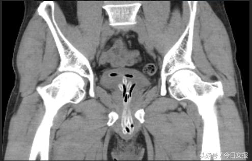男性尿道进异物后果,膀胱内异物进入尿道