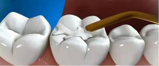 北京口腔医院修复科王淑英,补牙全冠和嵌体的哪个好