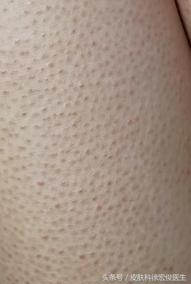 脸颊鸡皮肤显得脸色很难看,鸡皮肤太丑怎么办啊