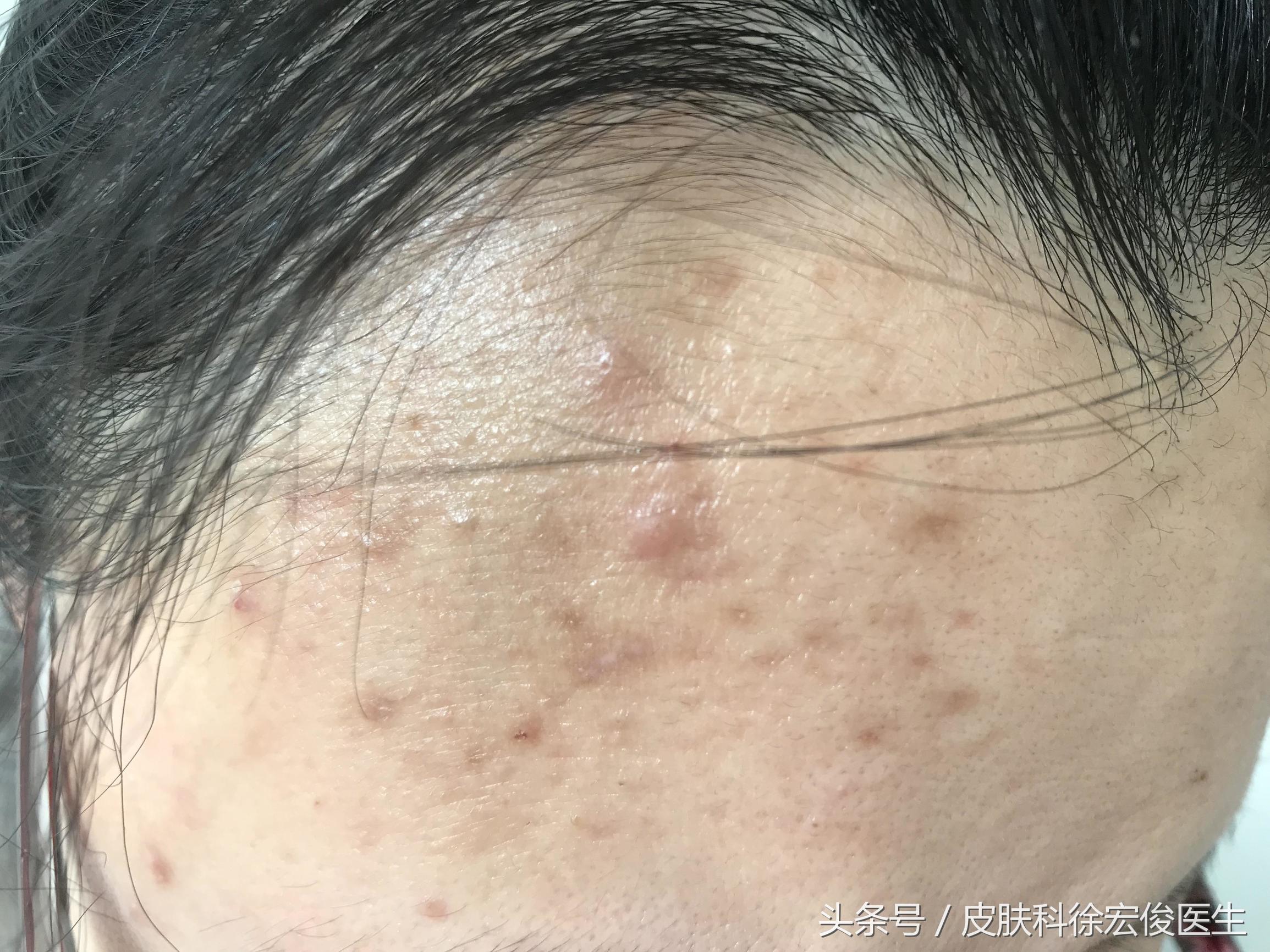 激素没有那么可怕,激素是不是根本不治病