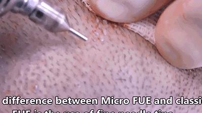 麦当劳薯条治疗脱发,麦当劳薯条掉头发