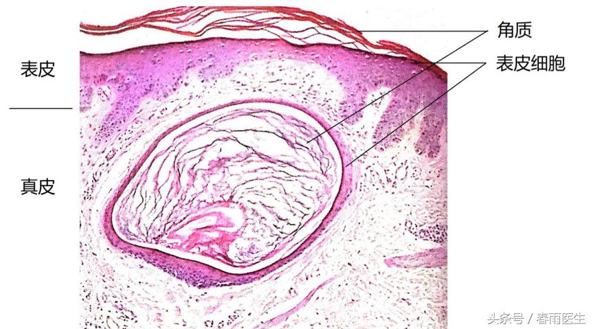 眼睛长了脂肪粒什么产品有效,眼周围长脂肪粒和护肤品有关吗