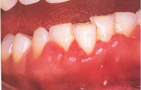 过年牙龈肿痛怎么办,食物残渣造成的牙龈肿痛怎么办