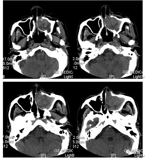 73岁患者无明显诱因出现左鼻塞、流脓涕，CT平扫发现密度影，怎么诊断？