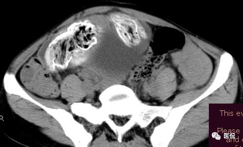 手术纱布遗留在体内可以吸收吗,手术纱布忘了取出会怎样