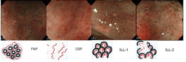 内镜检查痛苦吗,内镜检查是怎么做的