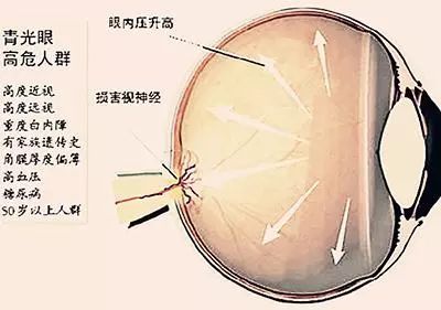 世界青光眼治疗最新进展,什么是青光眼青光眼要怎么治疗