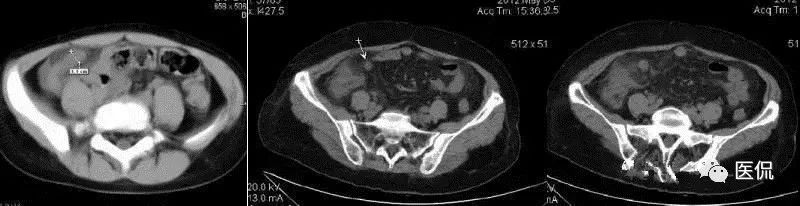 阑尾的解剖和影像表现,阑尾炎的32种鉴别诊断