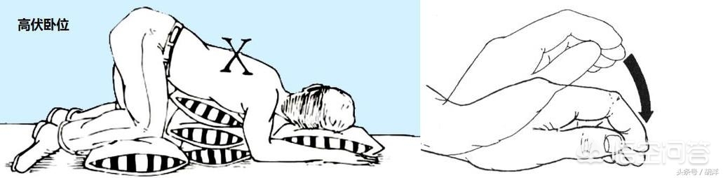 支气管扩张能治好吗,支气管扩张可以完全治愈吗