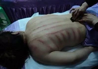 感冒喉咙痛刮痧刮哪个部位呢,感冒流清鼻涕刮痧刮哪里图解